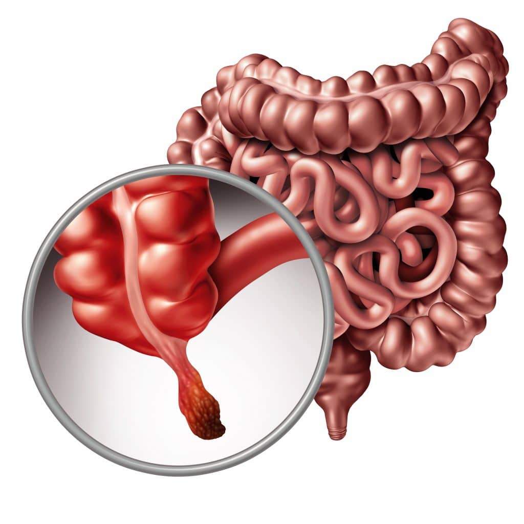 Cirurgia de apendicite